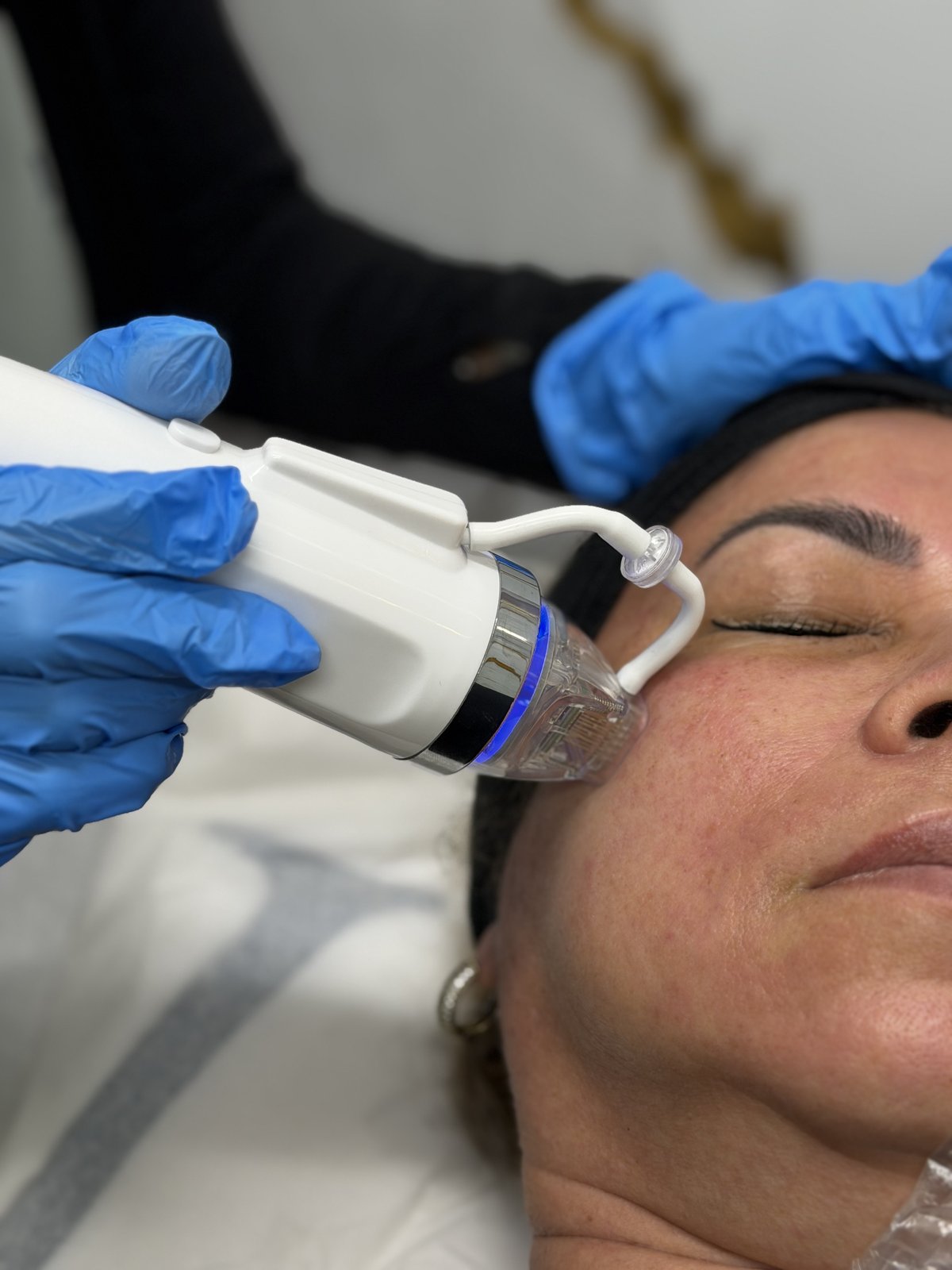 Radiofrequency microneedling facial treatment at IV Drop Revival & Glow in Miami